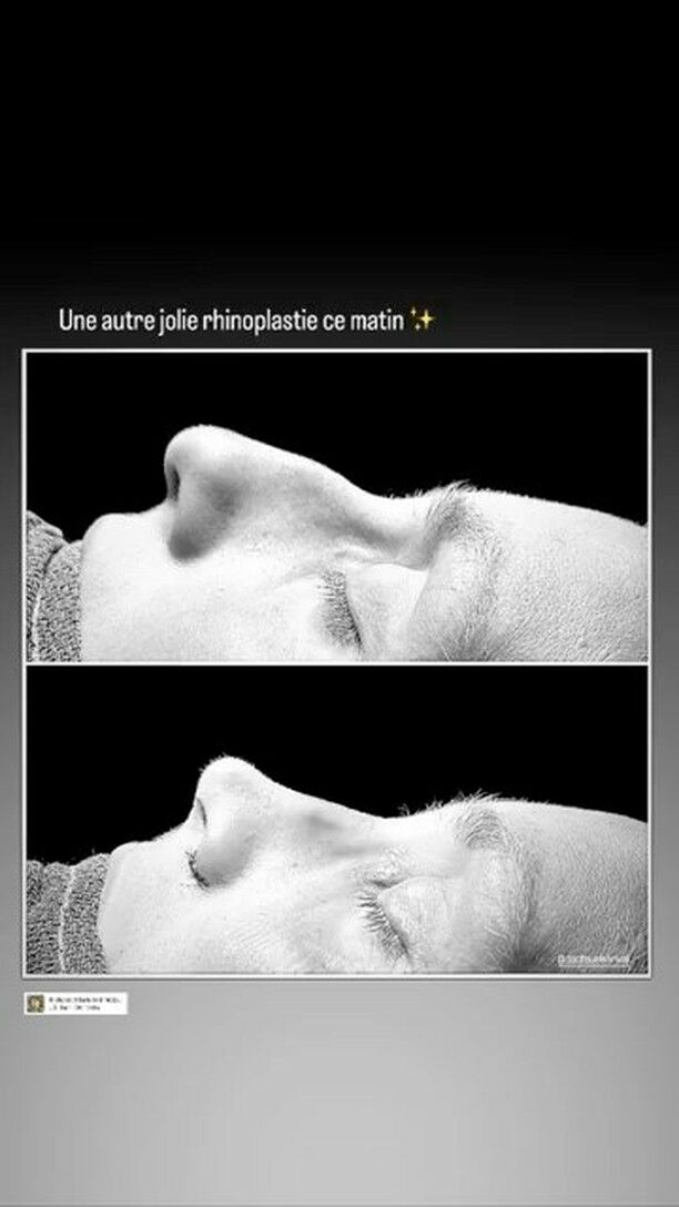La rhino c’est super ! Mais ce n’est pas magique … quelques petits rappels sur les imperfections 

#rhinoplasty #rhinoplastyexpert #chirurgieesthetique #biarritz
