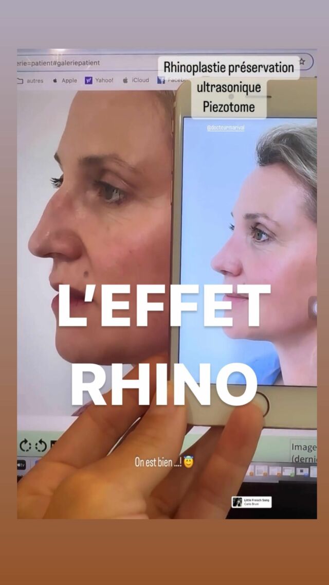 Tant que cela me fera cet effet là
Tant que cela vous fera cet effet là 
je ferai encore et encore des rhinoplasties 👃
La rhino fait partie des interventions les plus challengeuses en chirurgie plastique 
Mais quand on aime …. 🥰

Technique de rhino par préservation au piezotome 
Toute la précision grâce aux ultrasons ✨
Travail complet de la bosse et de la pointe 

Merci à toi K pour ta confiance et ton partage photos 🙏

#rhinopassion #rhinoexpert #ultrasound #piezotome #piezorhinoplasty #rhinoplastie #rhinopreservation #jobpassion #aestheticsurgery #drtaliamarival #biarritz #paysbasque #basquecountry #landes #carlabruni
