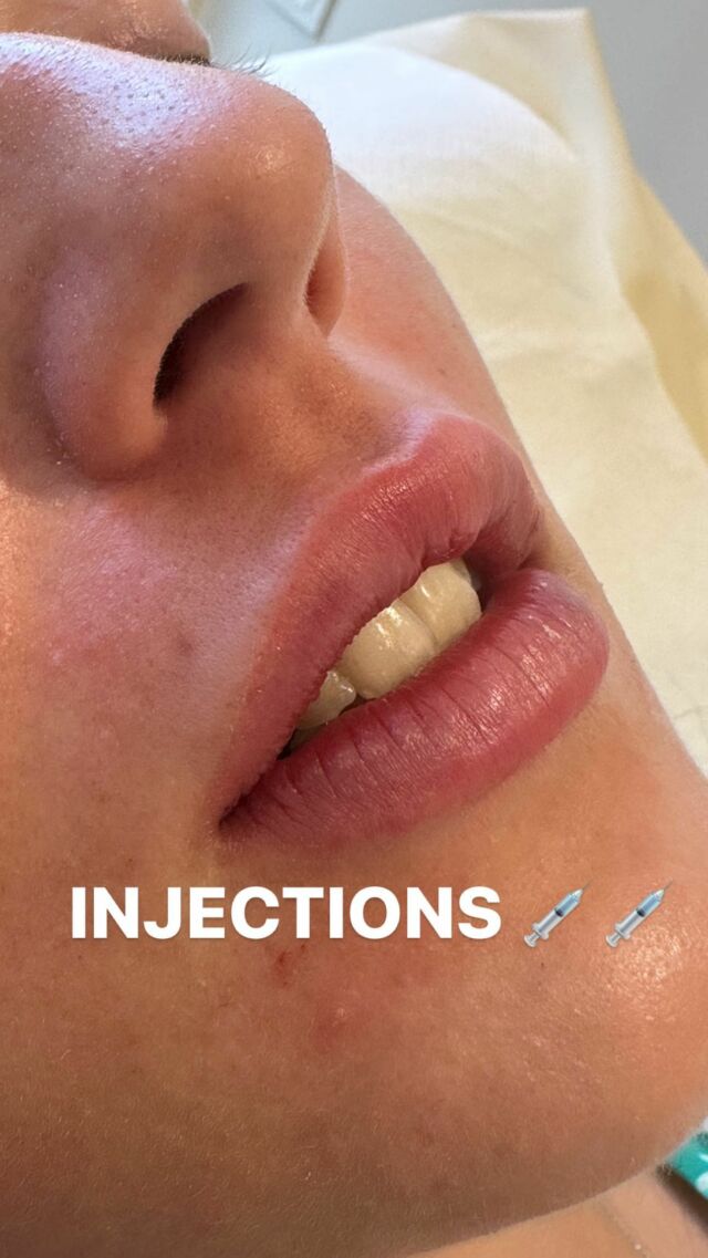 Point INJECTIONS 💉💉💉
Anciens patients : OUI ✅
Nouveaux patients : ÇA DÉPEND ! 😜
Vous le savez, Nous avons dû fermer un peu les vannes pour les nouveaux patients car trop de délai pour toutes vous injecter 
Mais …! Mais ! 
Parfois, nous débloquons des petites journées «  spéciales injections » où nous ouvrons les vannes de nouveau aux nouvelles (et aux anciennes patientes aussi en attente d’un rdv ) 

Et vous savez quoi? La prochaine est tout bientôt ! 🤫
Une idée de quand ? 

Et vous, ferez vous partie des VIP 😎 ou pas ?! 

** ceci n’est valable que pour les injections 
Pour la chirurgie, aucun soucis, pas de fermeture !

#injections #acidehyaluronique #botox #botoxday #nowinkles #chirurgieesthetique #medecineesthetique #biarritz #drtaliamarival #vip